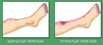 Открытые и закрытые переломы. Первая помощь при переломах